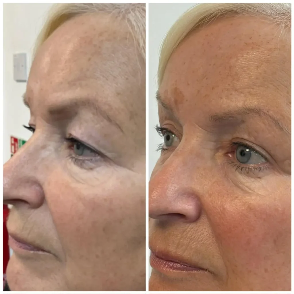 blepharoplasty eye area rejuvenation results 10