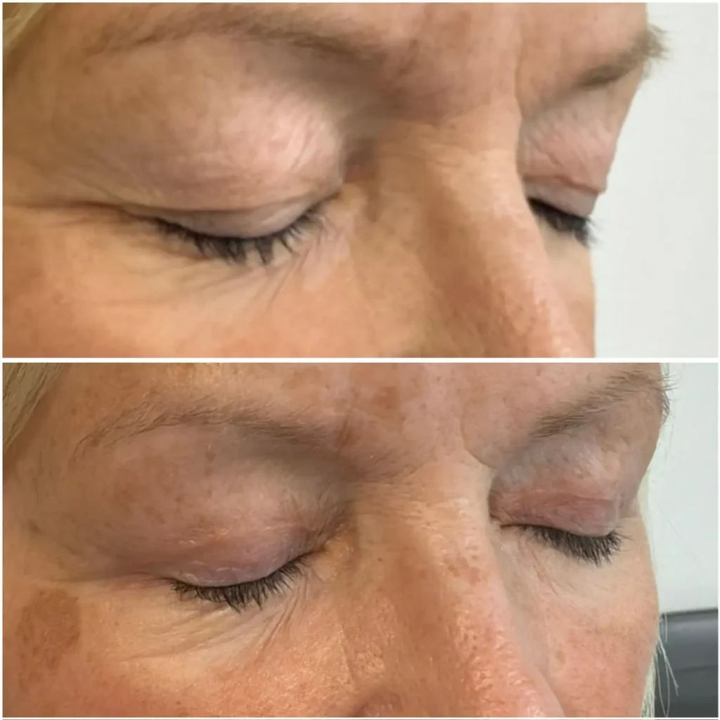 blepharoplasty eyelid rejuvenation healing stage 04