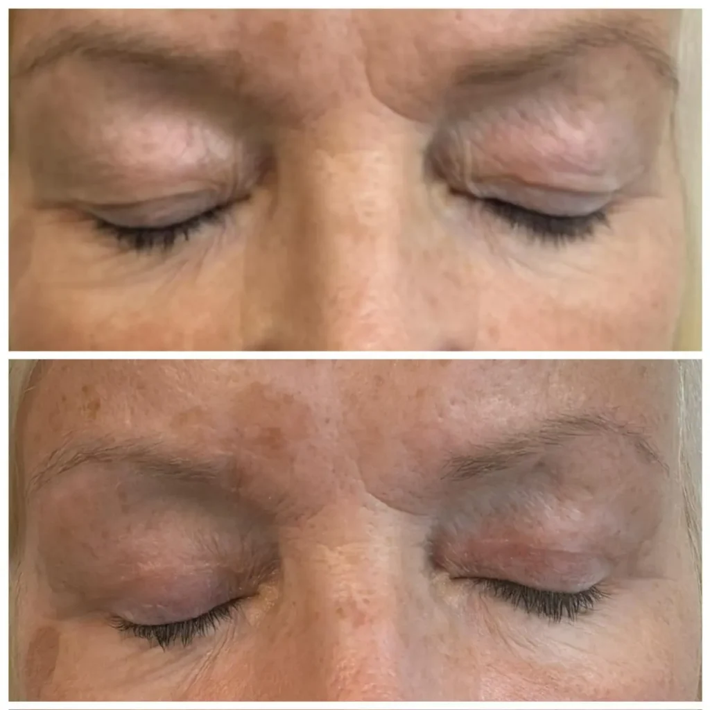 blepharoplasty eyelid skin treatment comparison 08