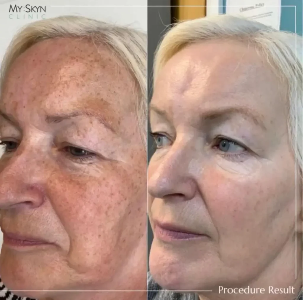 blepharoplasty periorbital rejuvenation before after 02