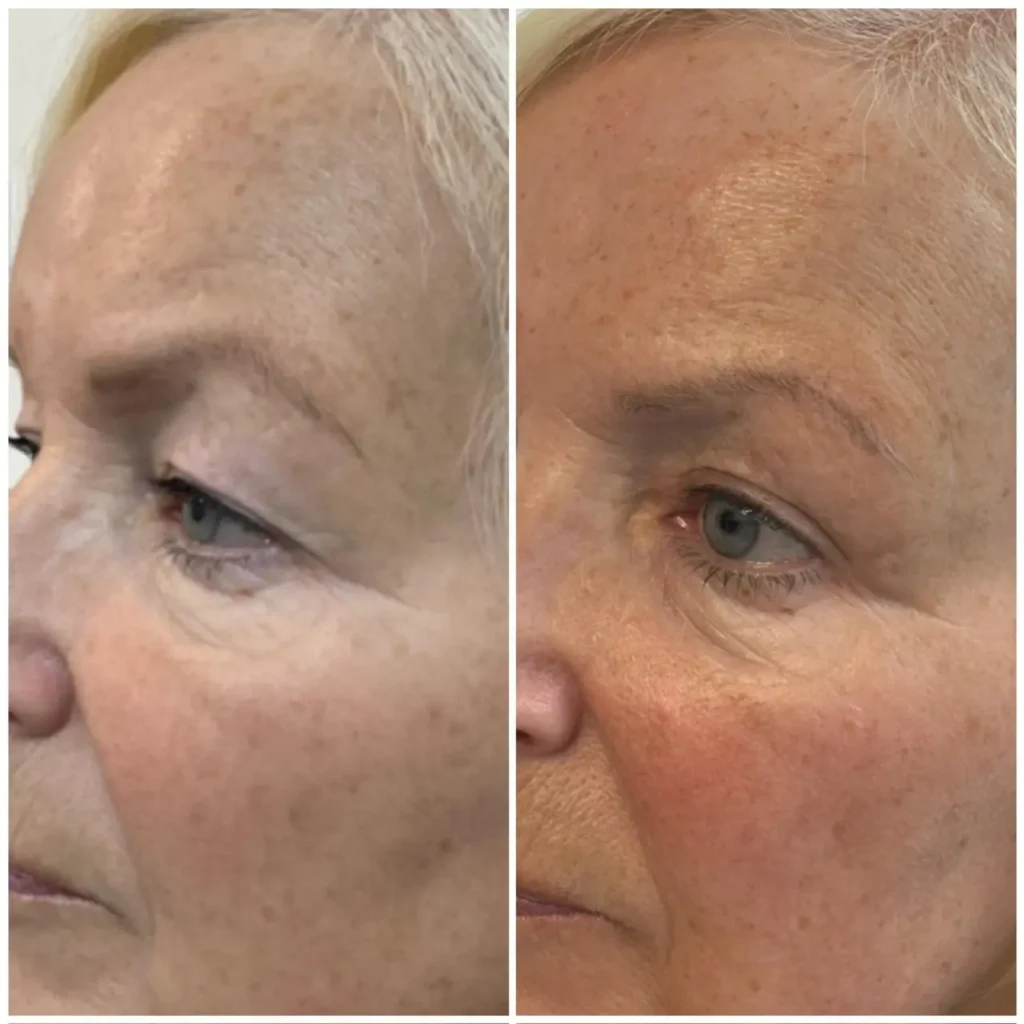 blepharoplasty periorbital rejuvenation results 07