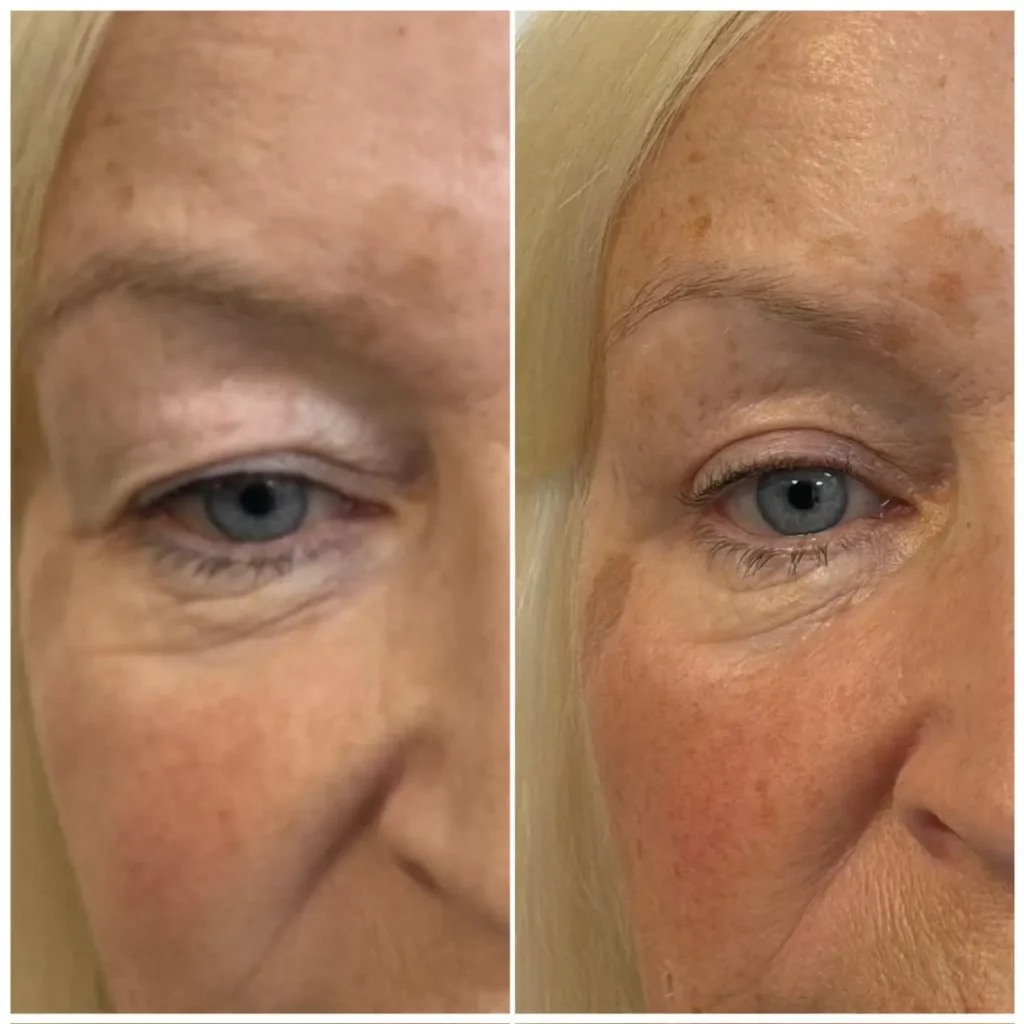 blepharoplasty upper blepharoplasty before after 06