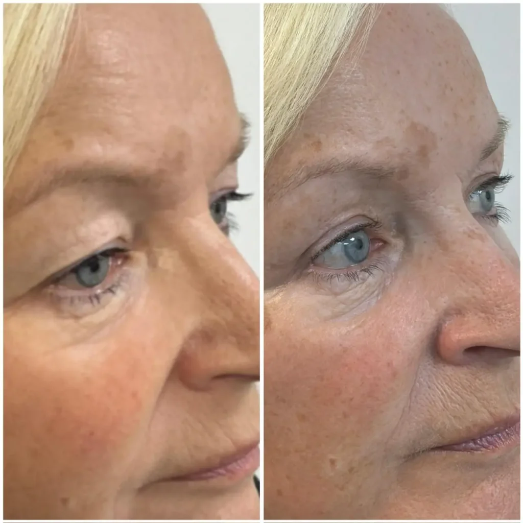 blepharoplasty upper blepharoplasty results 03