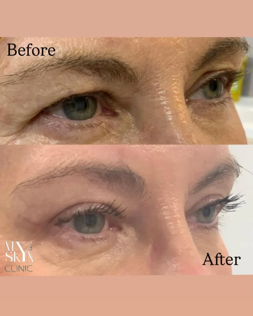 blepharoplasty upper eyelid before after 01