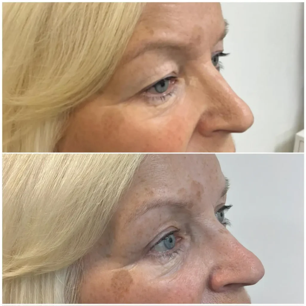 blepharoplasty upper eyelid correction results 05