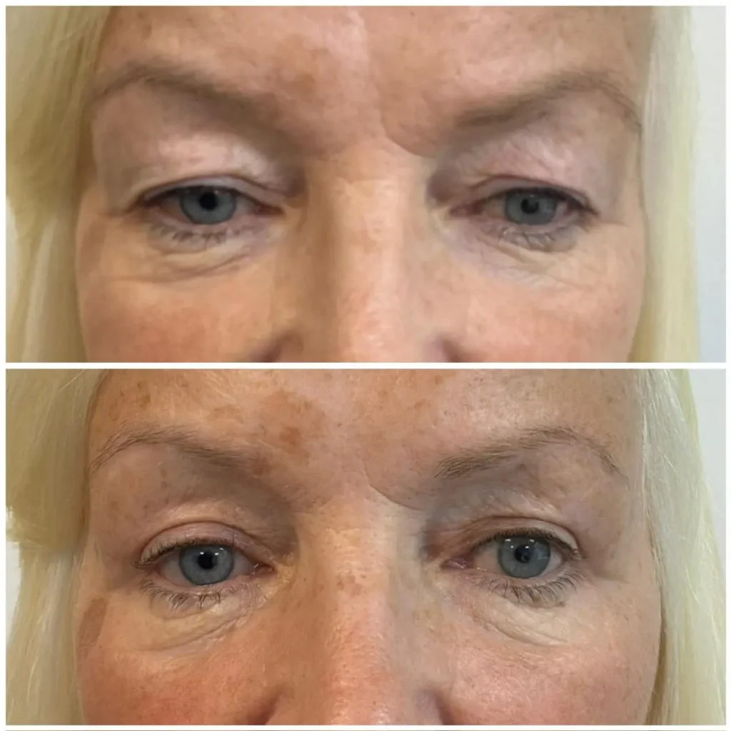 blepharoplasty upper eyelid lift before after 09