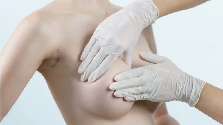 breast implant removal