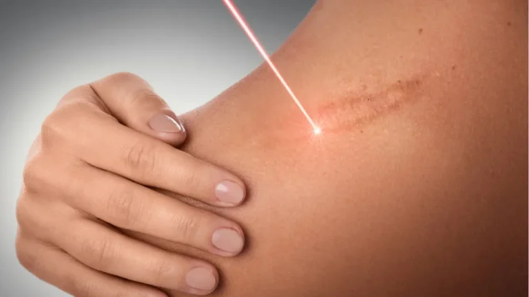 laser scar revision