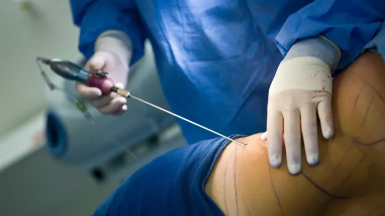 liposuction