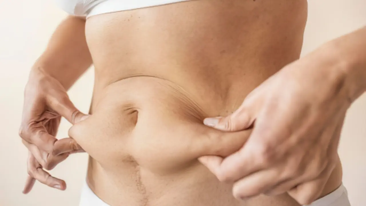 tummy tuck